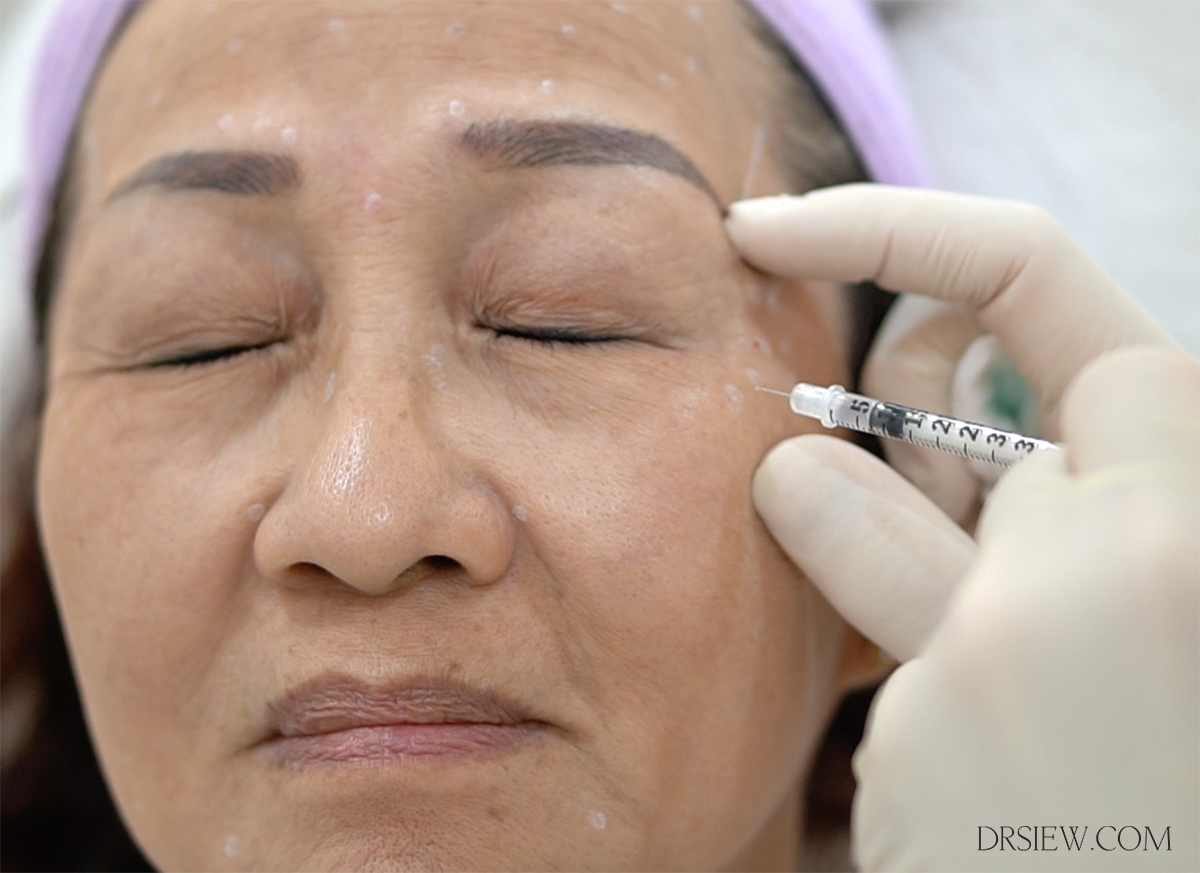 Dr-Siew-Xeomin-Botox-Dysport-procedure