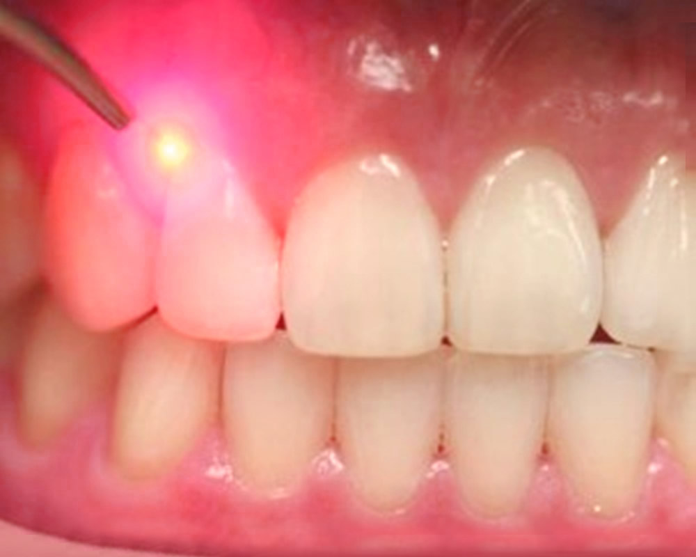 laser-canker-sore-treatment